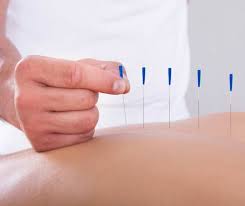 Balancing Body and Mind: Acupuncture in Port Moody post thumbnail image